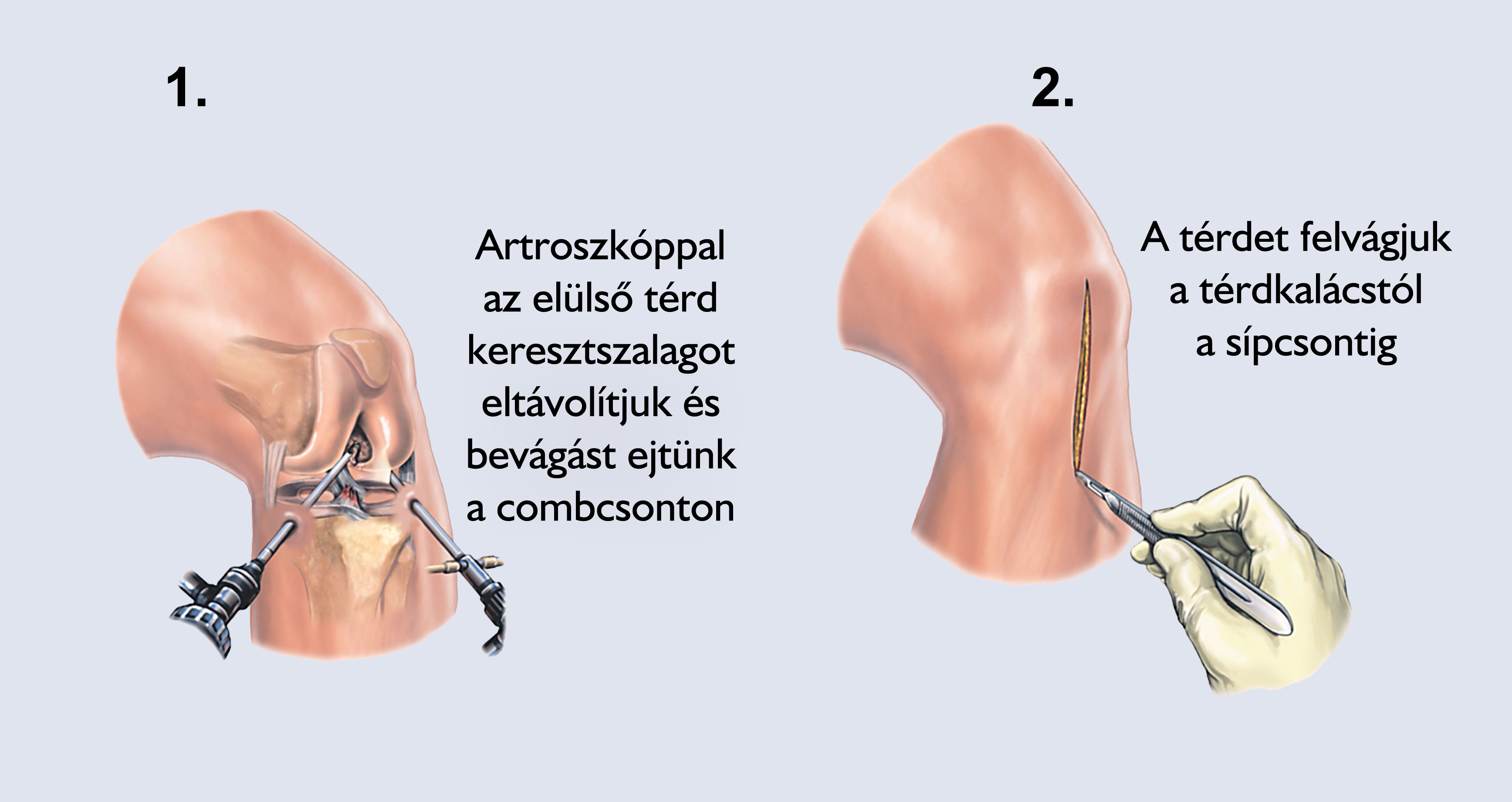 Artroszkópos térdműtét - Medicover