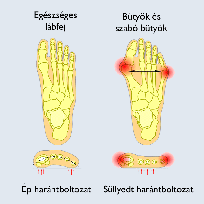 fájdalmat okoz a nagy lábujjak ízületei a térd második fokú artrózisának kezelése