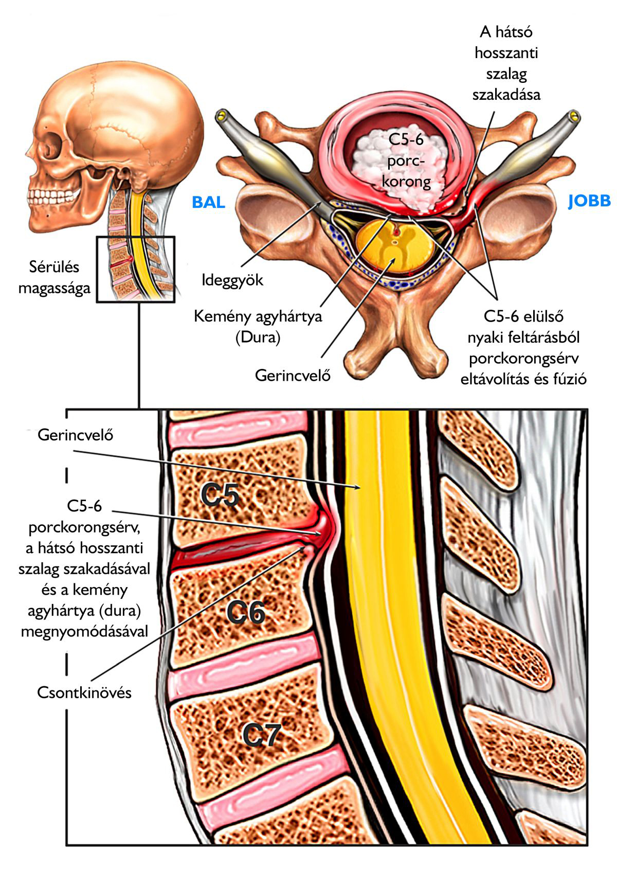 komplex a nyaki gerinc osteochondrosisára fájdalom a bal könyökízületben