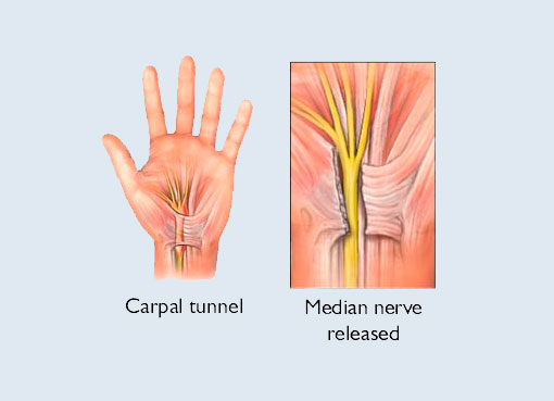 Carpal tunnel syndrome surgery, Carpalis tunnel release surgery - Medicover