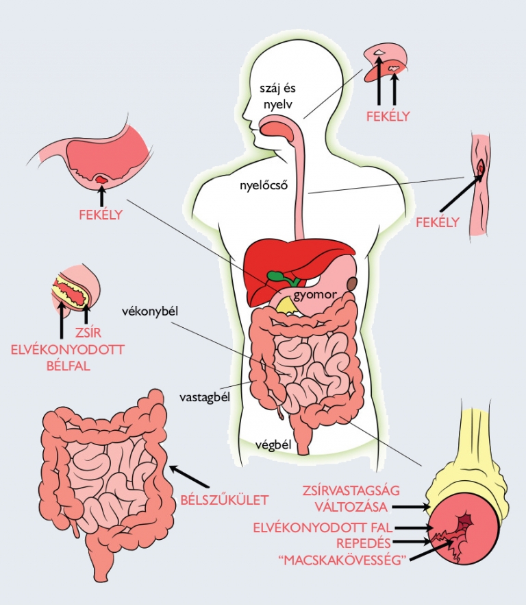Ízületi fájdalom és colitis - A colitis ulcerosa szövődményei