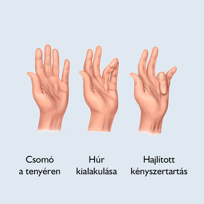 Középső ujj ízületi fájdalma a tenyérnél, Nyeregízületi artrózis