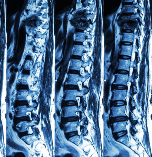 A nyaki osteochondrosis tünetei: a betegség minden jele - Hondrostrong