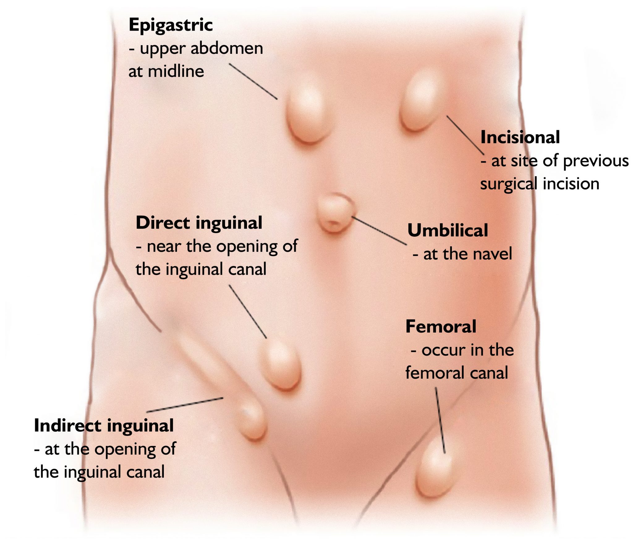 Umbilical Hernia: Its Complications and Treatment
