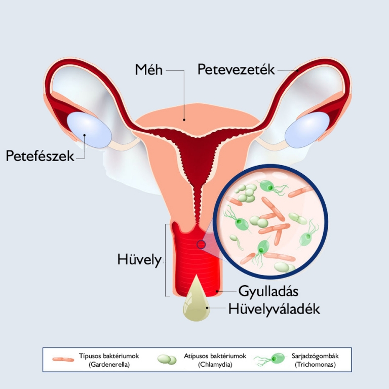 ízületi gyulladás vaginitis
