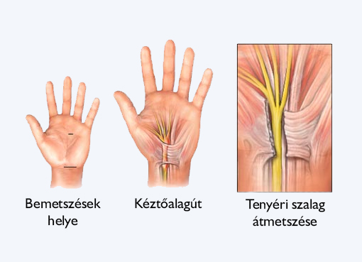 a kezem | Carpalis alagút szindróma? | Dr. Sallai Péter