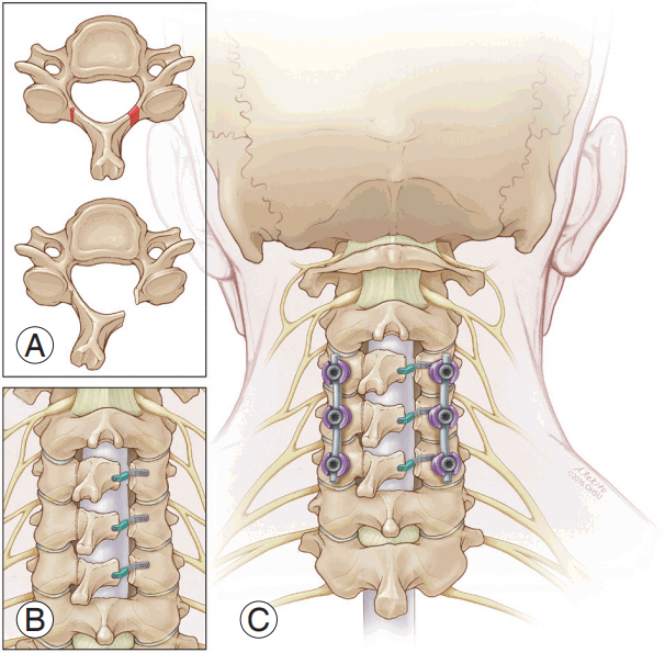 A nyaki (cervicalis) gerinc betegségei
