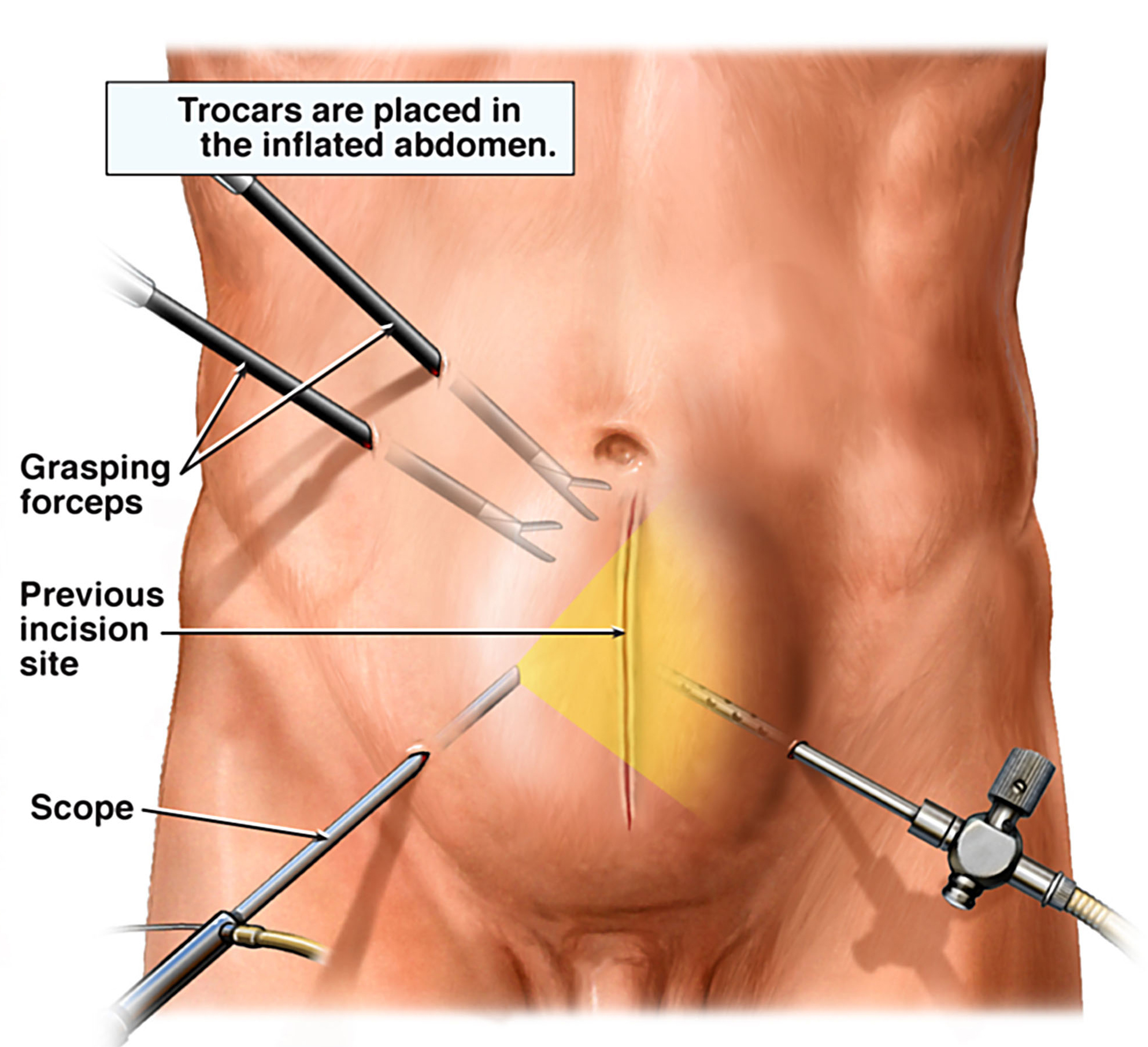 https://medicover.hu/wp-content/uploads/2022/02/laparoscopy-hernia-repair.jpg