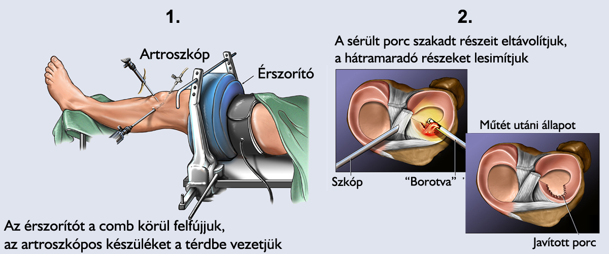 Artroszkópos térdműtét