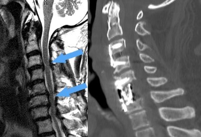 a nyaki gerinc chondrosisa 4. fokú arthrosis kezelése