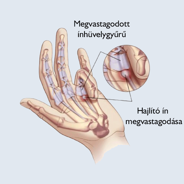 Középső ujj ízületi fájdalma a tenyérnél