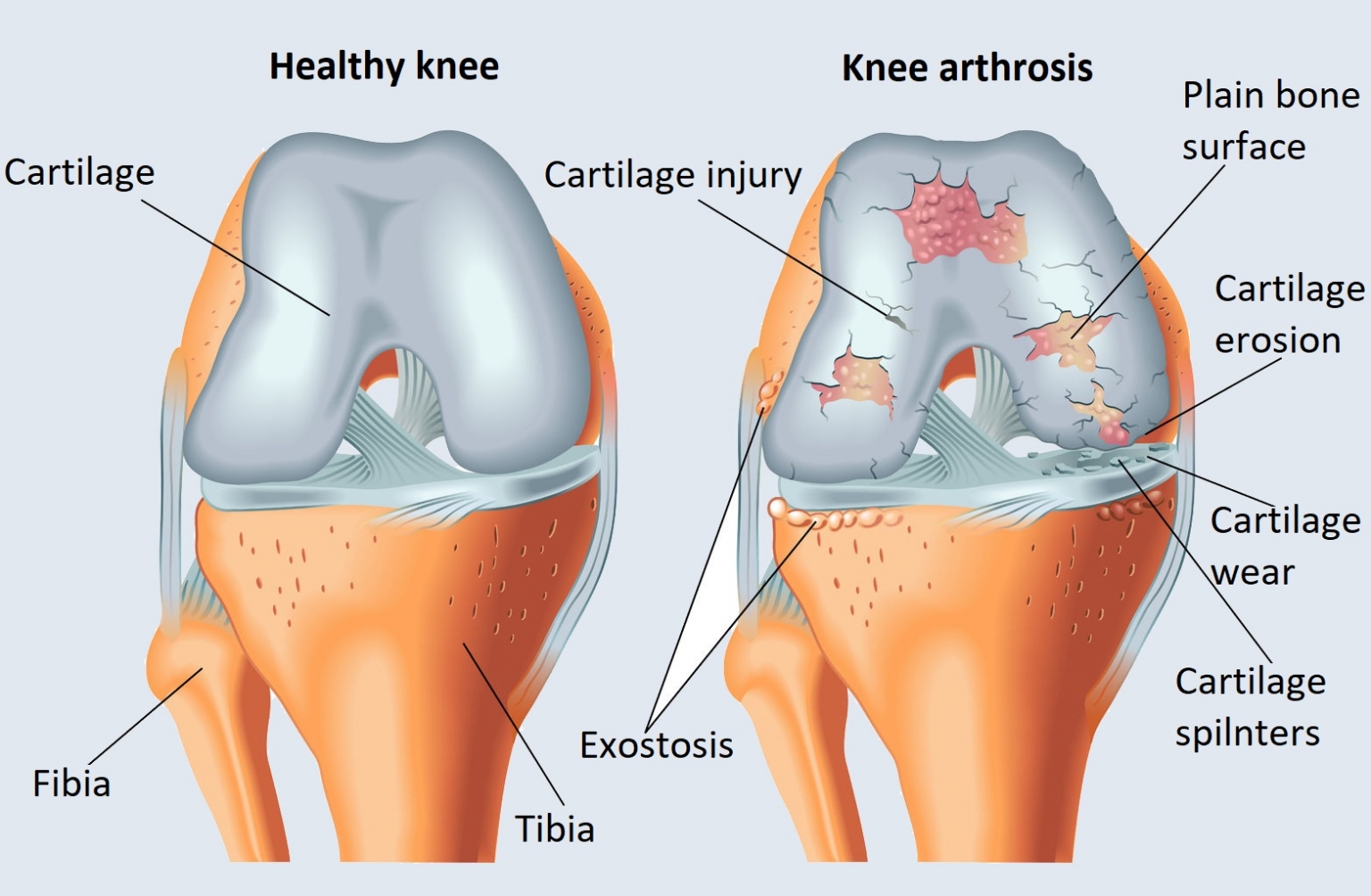 az artrózis kezelésének időszaka