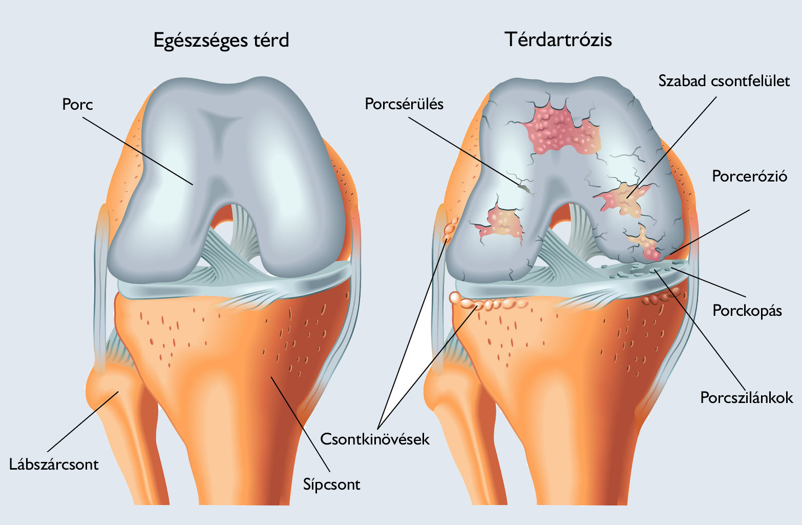 Újdonságok a deformáló artrózis kezelésében - Izomfájdalom inak ízületek