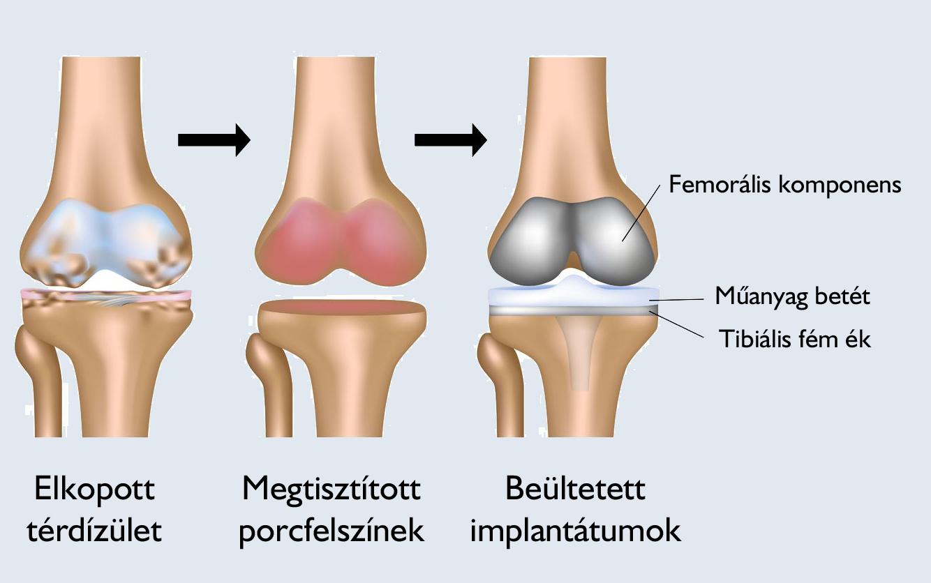 fájdalom a térd protézisek után