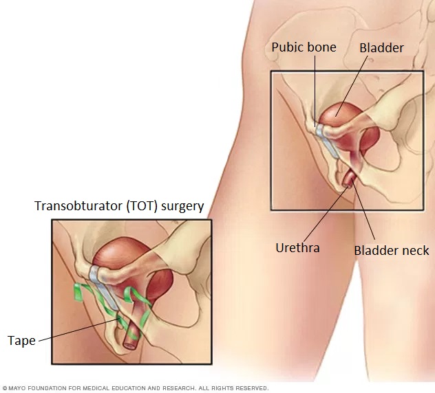 Anti-incontinence (TOT – Transobturator tape) surgery Medicover