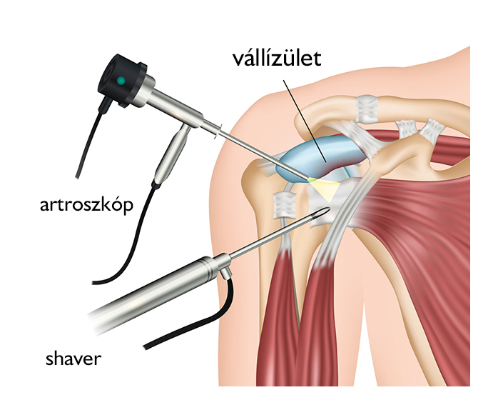 ultrahang artróziskezelő eszközök