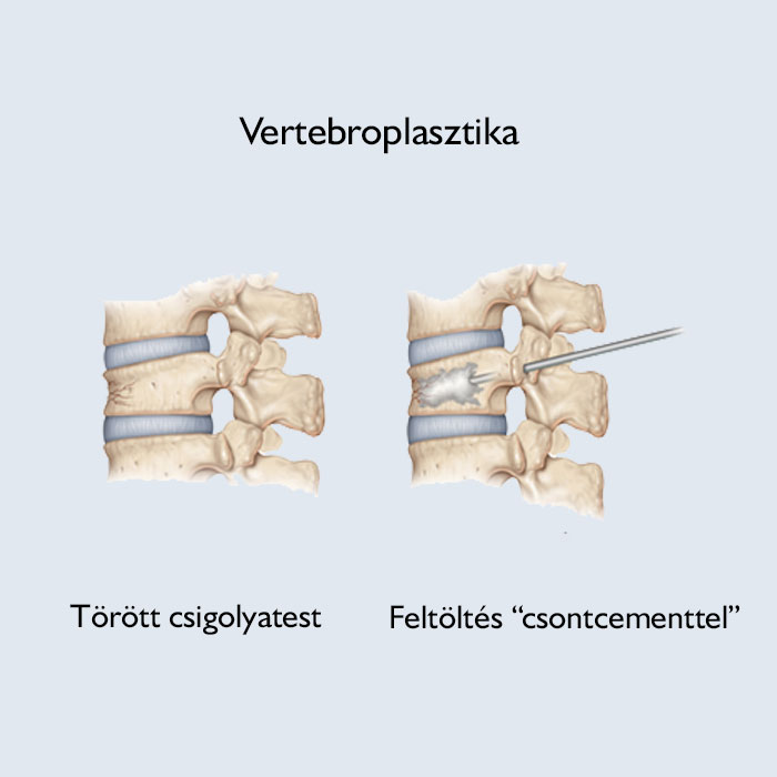 Mi történik a vertebroplasztika során?