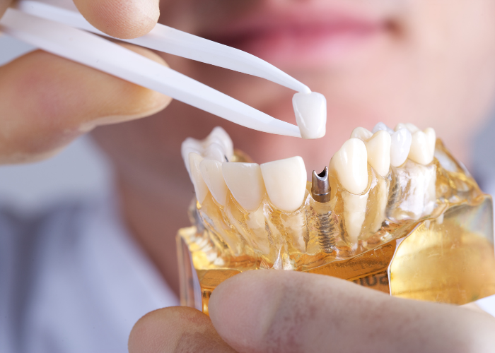 Drága fogászati ellátás is járhat ingyen: méltányossági alapon kérvényezhető - Egészség | Femina