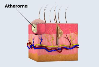 Atheroma (kásadaganat)