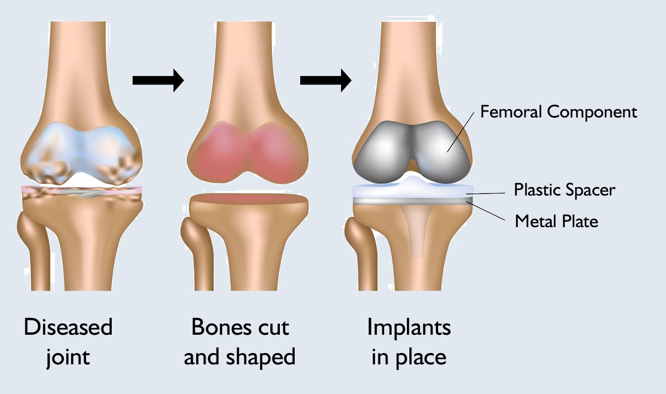 knee-replacement